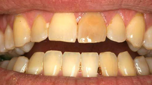 разваливающиеся зубы